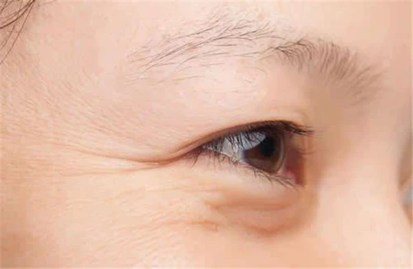 眼角纹多是什么原因 护肤 第7张