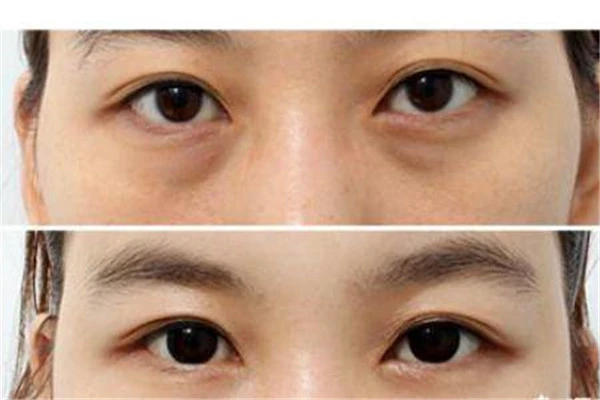 让眼袋消失的「妙招」：「外路」去眼袋紧致下眼皮 眼袋 妙招 第2张