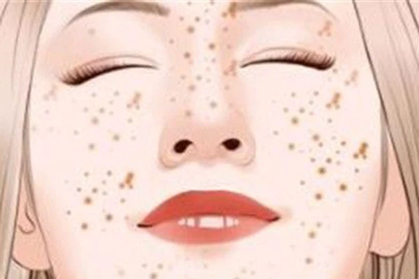 日常雀斑淡化小妙招 雀斑 第2张