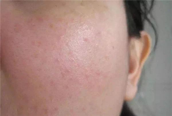 皮肤过敏的原因有哪些，哪些人容易皮肤过敏 过敏 皮肤 第4张