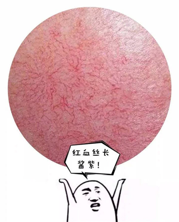 脸上红血丝一般后天形成，血液循环受阻引起等 脸上 红血丝 第2张