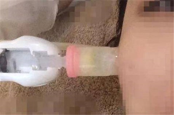 微针与水光针的区别：作用原理、治疗工具不同 微针 水光针 第1张