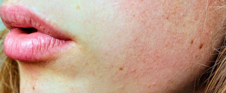 皮肤干燥脱皮怎么办 皮肤 干燥 脱皮 美妆 第2张 皮肤干燥脱皮怎么办 皮肤 干燥 脱皮 美妆 第2张