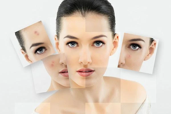 长了痘痘不小心弄破了要怎么处理 痘痘 第2张 长了痘痘不小心弄破了要怎么处理 痘痘 第2张