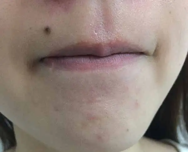 达尔肤杏仁酸温和焕肤精华液怎么样,达尔肤杏仁酸温和焕肤精华液使用测评 达尔肤 精华 第5张 达尔肤杏仁酸温和焕肤精华液怎么样,达尔肤杏仁酸温和焕肤精华液使用测评 达尔肤 精华 第5张