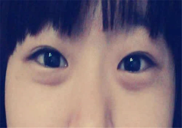 下眼袋可以去掉吗，只要发现的早，去除下眼袋就不是梦想！ 护肤 第3张