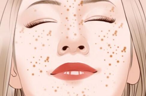 脸上有雀斑怎么办，雀斑形成的原因 雀斑 雀斑形成原因 雀斑形成的原因都有哪些图片 美容 第1张