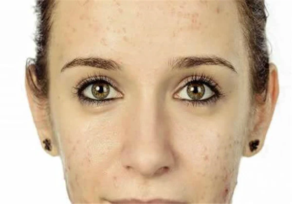 吃辣椒长痘痘怎么消除，吃辣椒长痘痘不用怕，这样祛痘再辣也敢吃！ 护肤 第6张