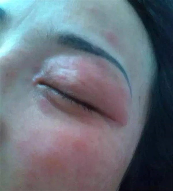 皮肤过敏的原因有哪些，哪些人容易皮肤过敏 过敏 皮肤 第5张