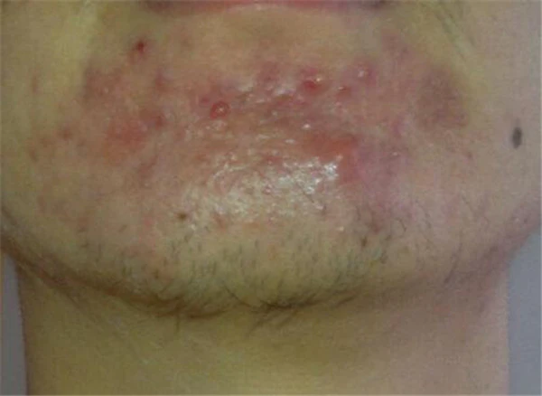 下巴痛有硬块怎么回事 护肤 第2张