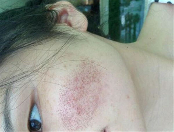 点阵激光后多久恢复正常肤色 护肤 第4张