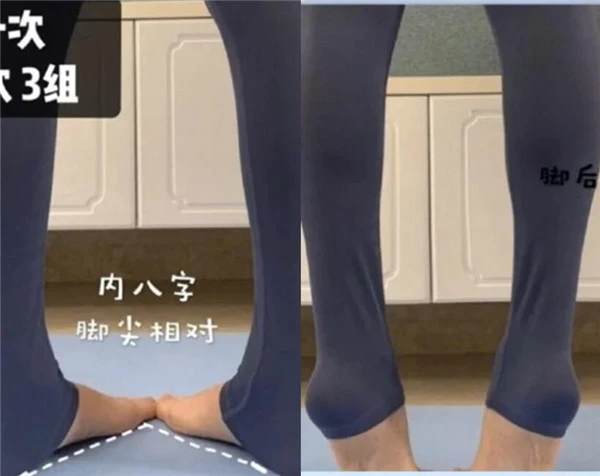 轻松改变小腿外翻瘦出筷子腿！如何判断小腿肌类型 筷子腿 小腿外翻 第6张