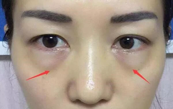 不手术就可去除眼袋的方法，隔夜茶热敷眼部或贴眼贴 眼袋 方法 第5张