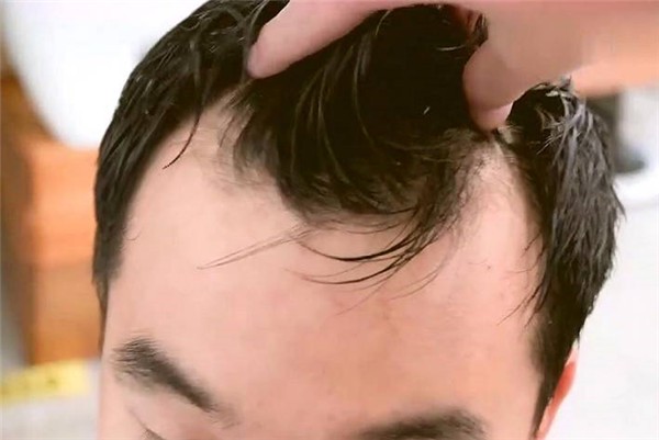 m字型发际线怎么办 发际线 m字型发际线 美妆 第1张