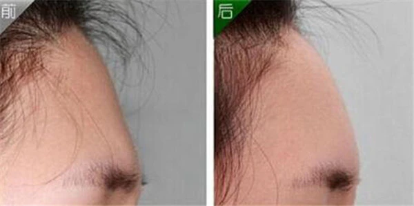 自体脂肪面部填充价格 护肤 第3张