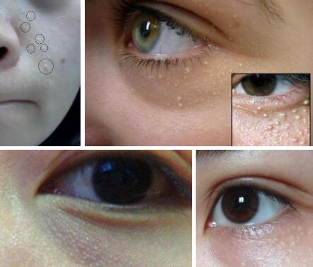 脸上长脂肪粒是什么原因，长脂肪粒的六大因素 脂肪粒 脸上长脂肪粒的原因 美容 第1张