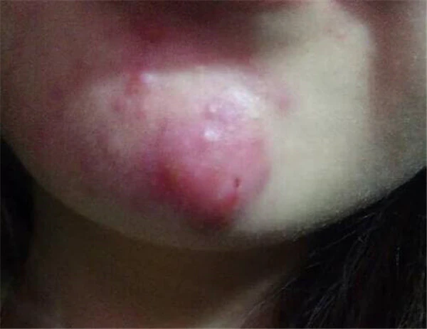 下巴痛有硬块怎么回事 护肤 第3张