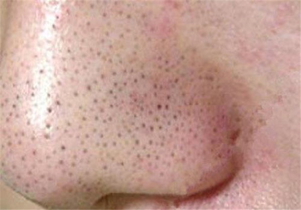 如何清除黑头和粉刺,清除黑头粉刺缩毛孔有妙招 护肤 第1张 如何清除黑头和粉刺,清除黑头粉刺缩毛孔有妙招 护肤 第1张