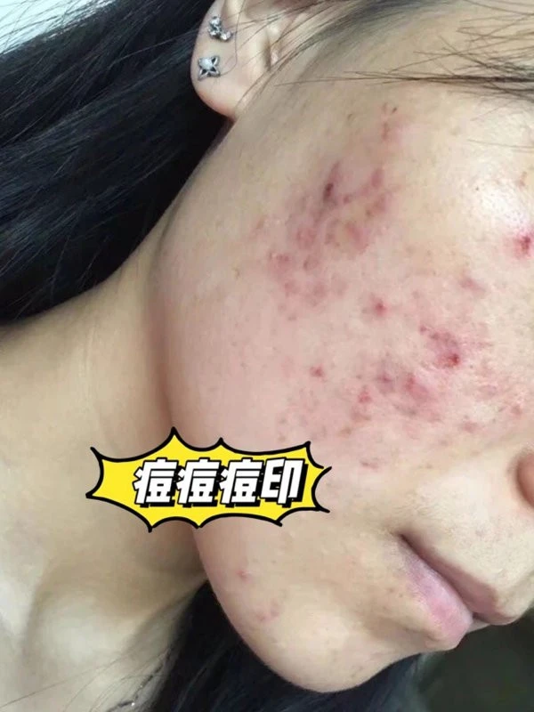 雄性激素导致痘痘形成，温水有助于新陈代谢 痘痘 新陈代谢 第2张