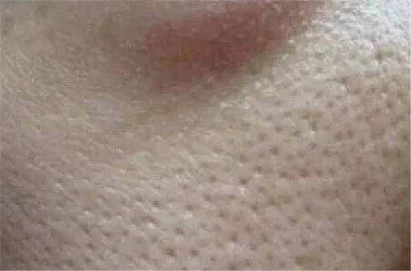 导致毛孔粗大的情况：皮肤老化松弛使用抗衰老护肤品 毛孔粗大 皮肤 第1张