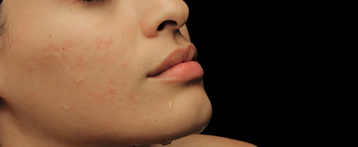 脸上长痘痘了怎么办 痘痘 美妆 第3张