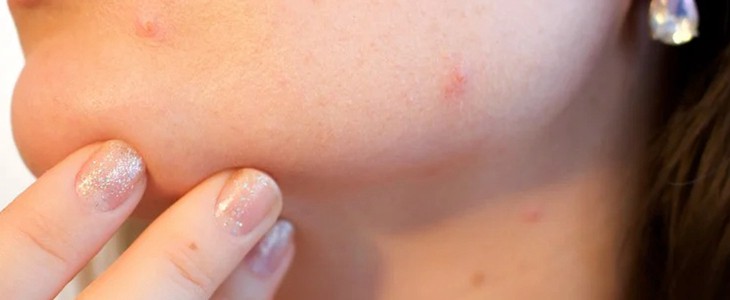 ve能去痘印吗 ve 痘印 美妆 第1张