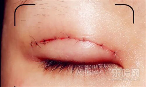 内双怎么变外双 护肤 第5张