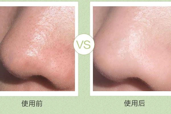 这样搭配使用荷荷巴油,去黑头效果更出众 黑头 第2张 这样搭配使用荷荷巴油,去黑头效果更出众 黑头 第2张