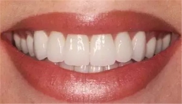 如何会拥有美白亮丽的牙齿，牙黄的美白方式有哪些 牙黄 美白 第1张
