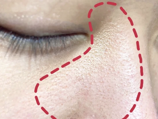 毛周角化为慢性毛囊角化性疾病，因毛孔堵塞出现红斑 毛周角化 疾病 第2张