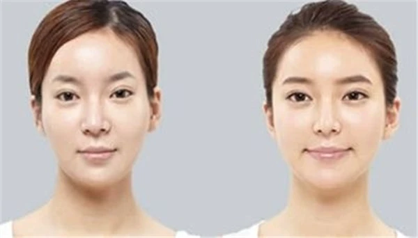 填充太阳穴的手术过程，玻尿酸填充完需要注意什么 太阳穴 手术过程 第2张