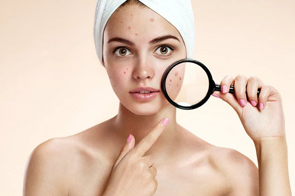痘痘肌护肤六大注意事项 肌肤 第2张