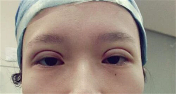 韩式三点双眼皮多久恢复好,韩式三点双眼皮恢复期 护肤 第3张 韩式三点双眼皮多久恢复好,韩式三点双眼皮恢复期 护肤 第3张