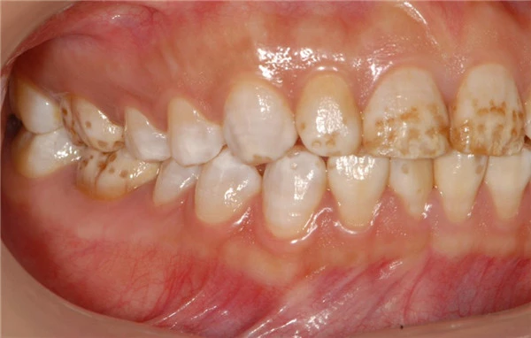 如何会拥有美白亮丽的牙齿，牙黄的美白方式有哪些 牙黄 美白 第3张