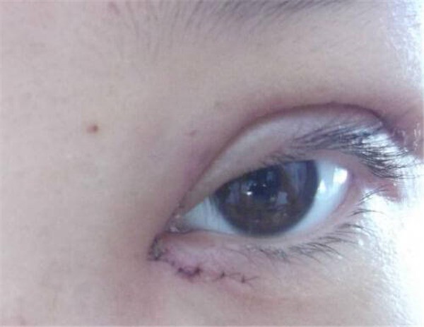 韩式三点双眼皮多久恢复好,韩式三点双眼皮恢复期 护肤 第1张 韩式三点双眼皮多久恢复好,韩式三点双眼皮恢复期 护肤 第1张