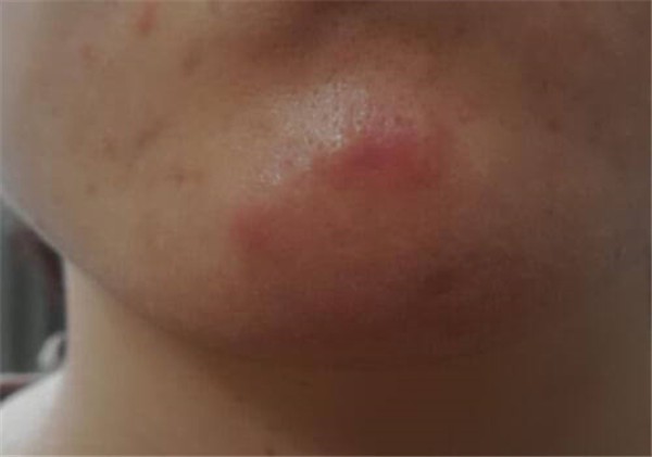 下巴痛有硬块怎么回事 护肤 第1张