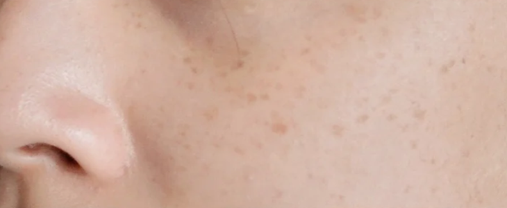 皮肤暗黄有色斑怎么办 皮肤 暗黄 色斑 美妆 第1张