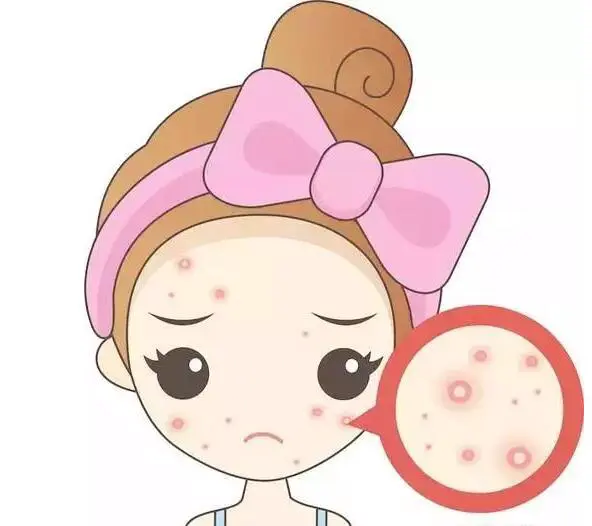 青春痘一般要长到几岁 青春痘 青春痘要长到几岁 美容 第2张