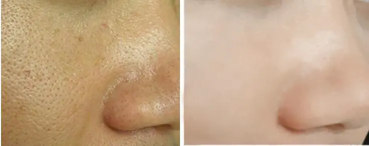 每次涂完粉底毛孔里有白点怎么办，化妆时卡粉解决方法 卡粉 涂完粉底毛孔里都是粉 涂完粉底毛孔里都是粉卡粉起皮怎么办 美妆 第2张