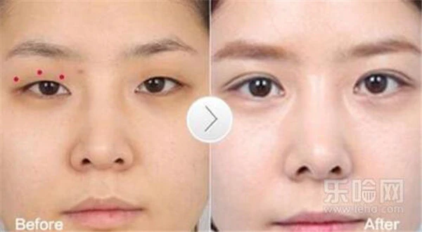 割双眼皮多少钱 护肤 第4张