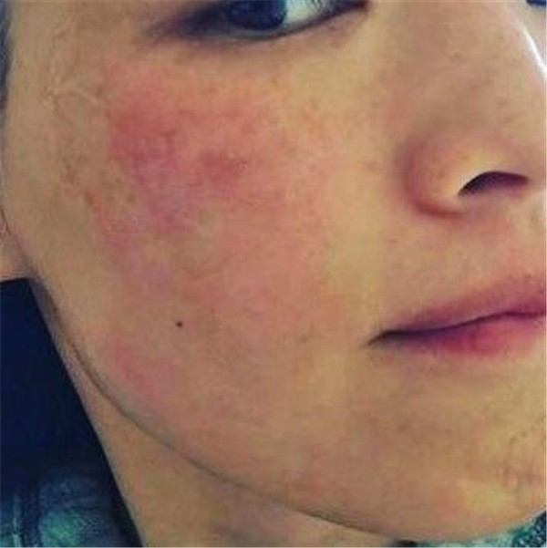 如何分辨「玫瑰痤疮」与「暗疮」，玫瑰痤疮常见4大病发阶段 玫瑰痤疮 暗疮 第1张