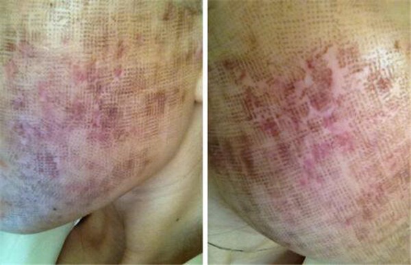 点阵激光后多久恢复正常肤色 护肤 第1张