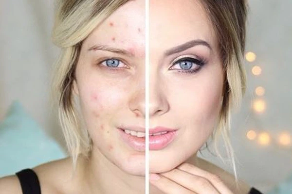 去除痘印要怎么做，去除痘印的几个小妙招 痘印 第2张