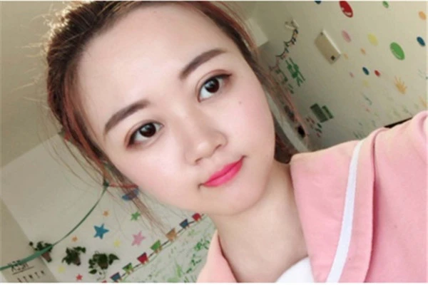 双眼皮手术全切保持的时间久，埋线保守不需开刀 双眼皮 手术 第3张