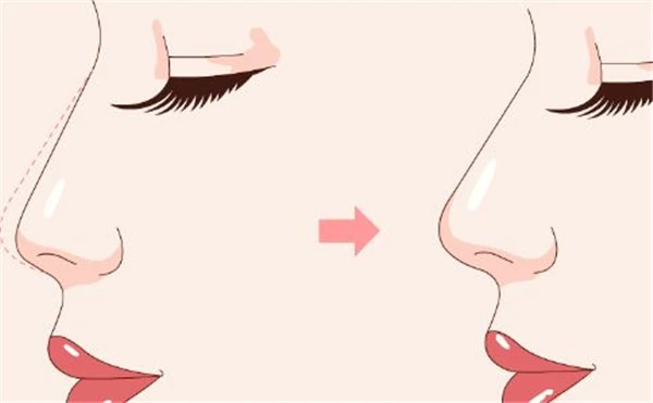 鼻头鼻翼如何缩小，鼻头鼻翼缩小效果明显吗 鼻头 鼻翼 第3张