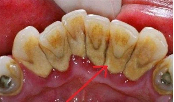 如何会拥有美白亮丽的牙齿，牙黄的美白方式有哪些 牙黄 美白 第2张