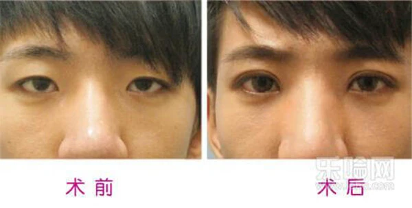 埋线双眼皮好吗 护肤 第4张