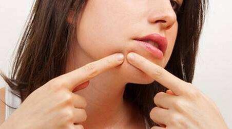 嘴巴周围老是长痘痘怎么办，嘴巴周围长痘痘原因 痘痘 嘴巴周围长痘痘 嘴巴周围长痘痘原因 美容 第1张