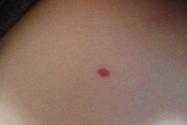 因为天气热脸上长红疙瘩怎么办 面部 第2张