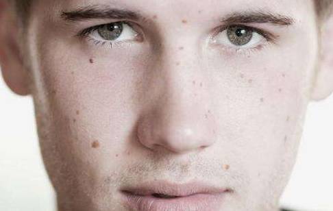 男人脸上长黄褐斑是什么原因,能去掉吗 黄褐斑 祛斑 美妆 第1张